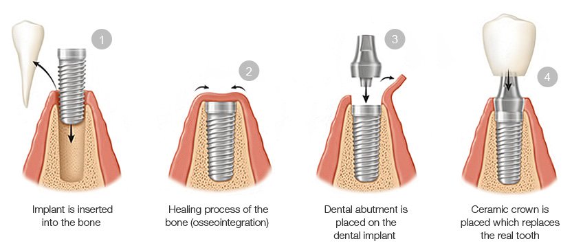 Dental Implant Procedure Steps Sandy, UT