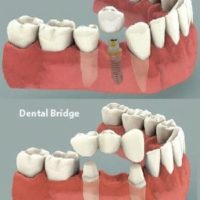 bridge_vs_implant-200x200