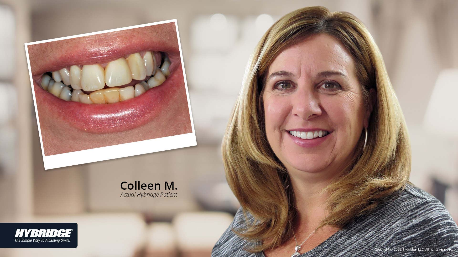 Colleen Hybridge Before & After